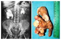 X-ray and photo of staghorn calculi.